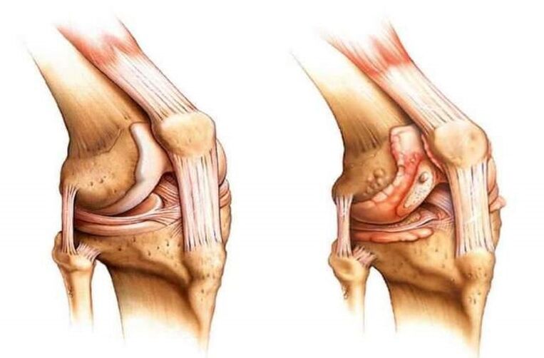 gesundes Knie und Arthrose des Kniegelenks