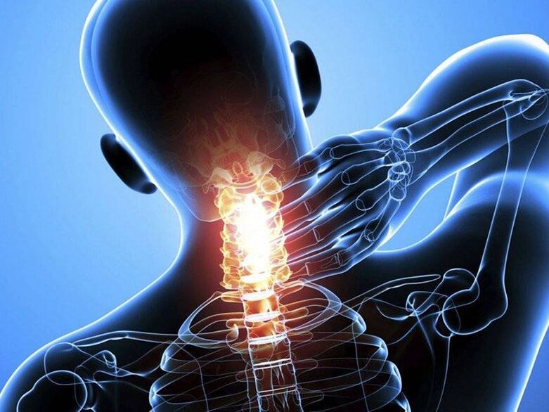 Osteochondrose der Halswirbelsäule wird von Nackenschmerzen begleitet