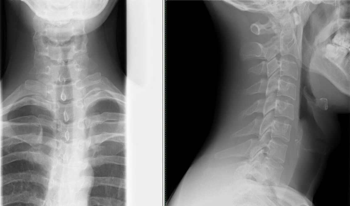 Das Röntgen der Wirbelsäule ist eine einfache und wirksame Methode zur Diagnose von Osteochondrose